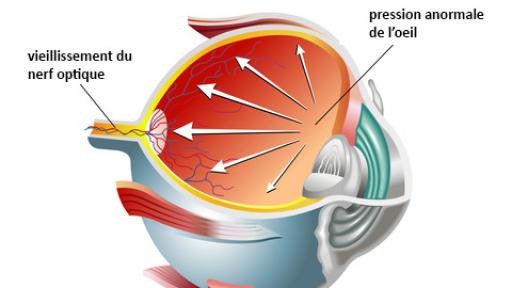 schéma de l'oeil présentant les effets du glaucome