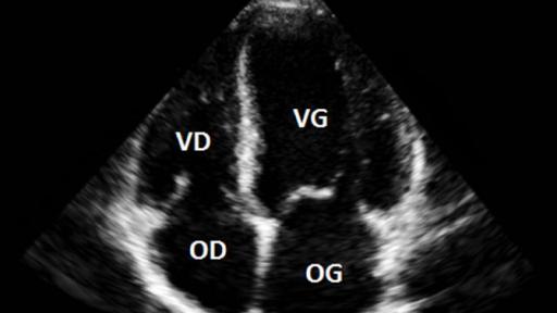 Vue du cœur en ETT (VD : ventricule droit / VG : ventricule gauche / OD : oreillette droit / OG : oreillette gauche