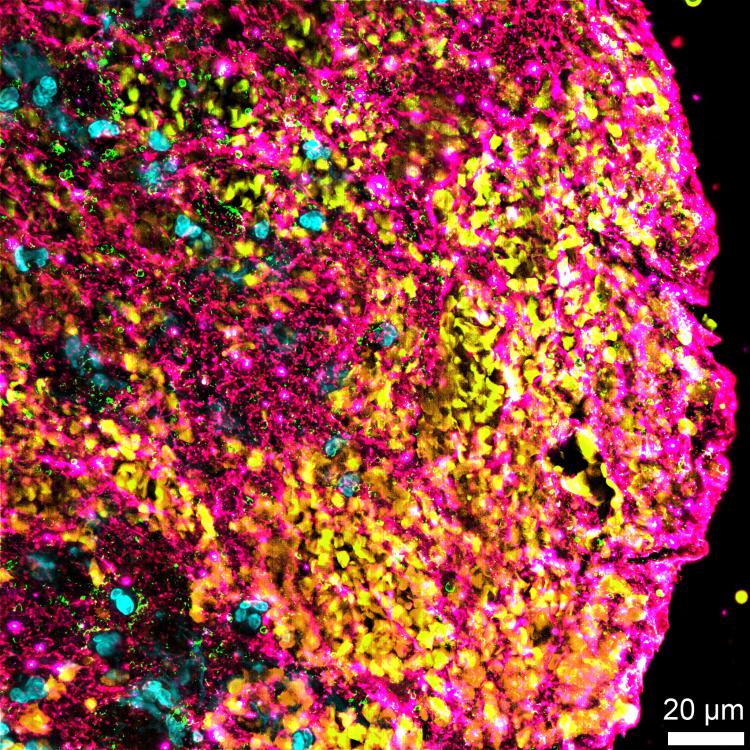 Caillot AVC grossit au microscope - Hôpital Fondation Rothschild