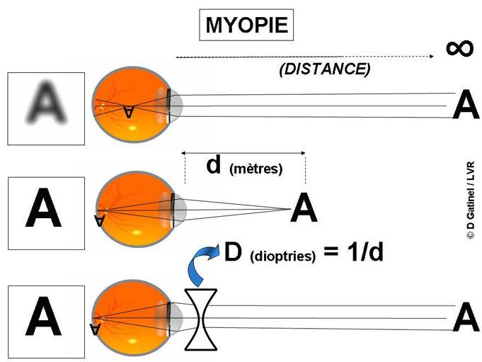 Schéma myopie