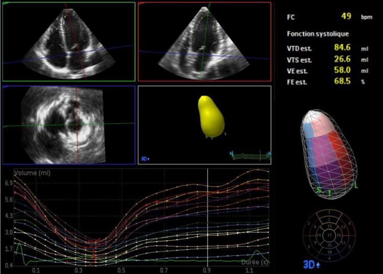 Vue du ventricule gauche en 3D en échographie