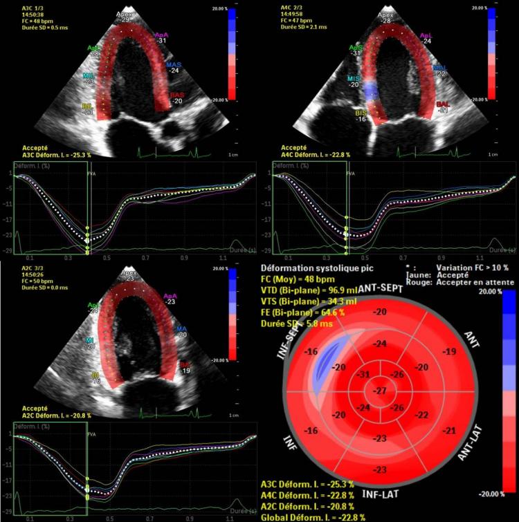 Déformation du ventricule gauche pour évaluer la fonction longitudinale