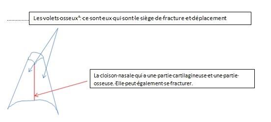 Schéma fracture du nez