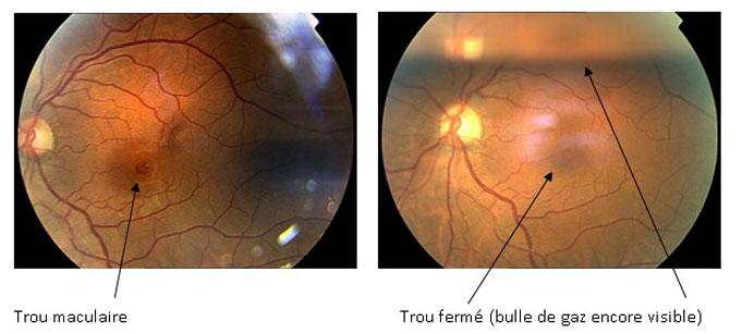 Trou maculaire rétine chirurgicale